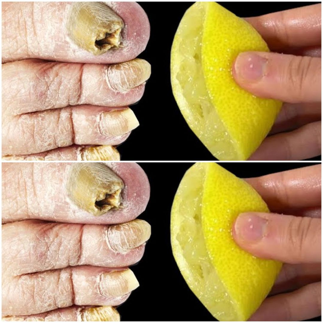 Say Goodbye to Nail Fungus with this Quick DIY Solution!