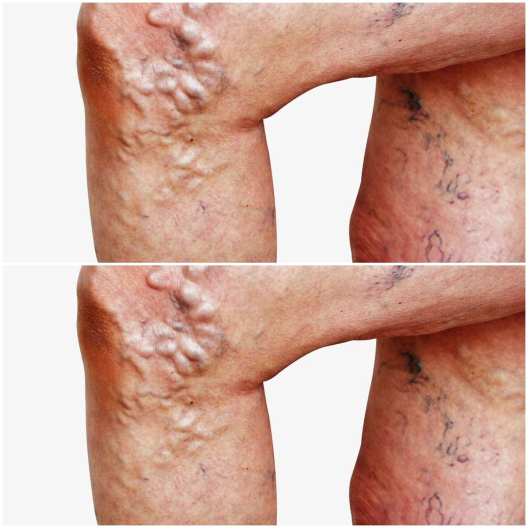 Discover the Extraordinary Natural Remedy for Varicose Veins: Pycnogenol