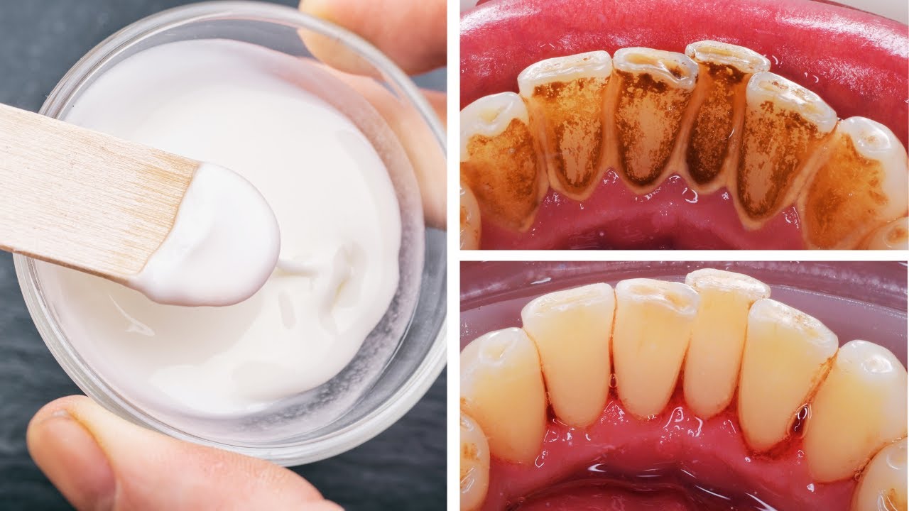 Unlocking the Power of Baking Soda for a Healthier Smile