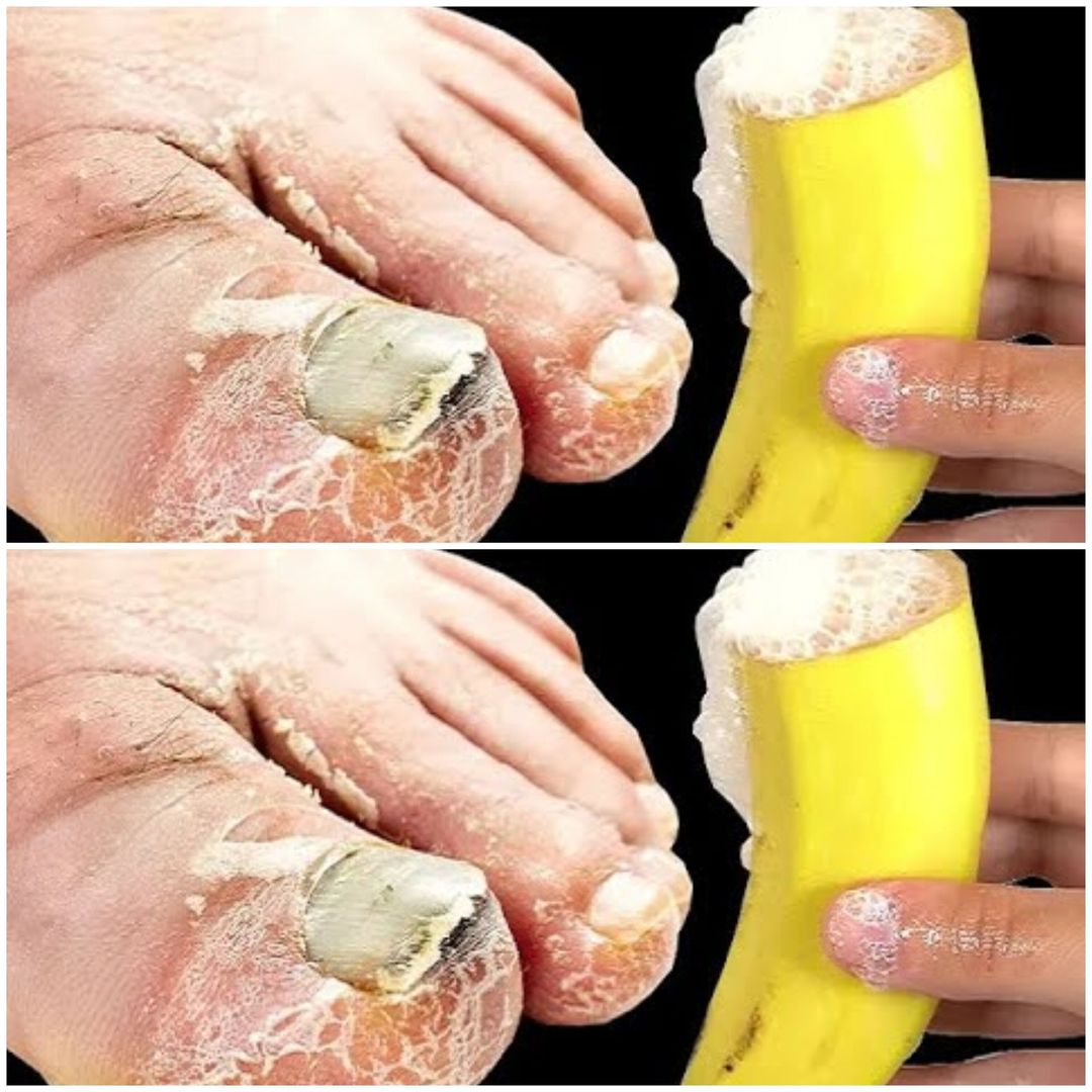 Say Goodbye to Toenail Fungus with This Easy Home Remedy!