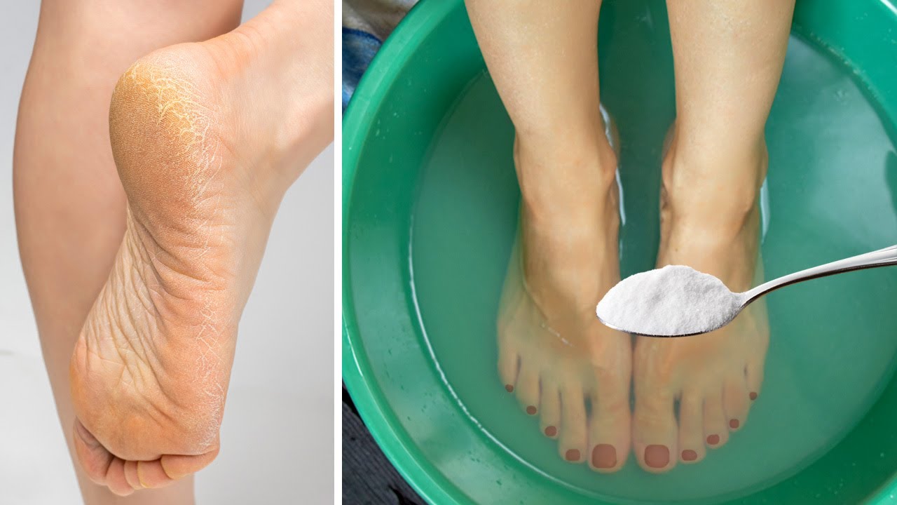 Say Goodbye to Cracked Heels Forever: A Magical Home Remedy