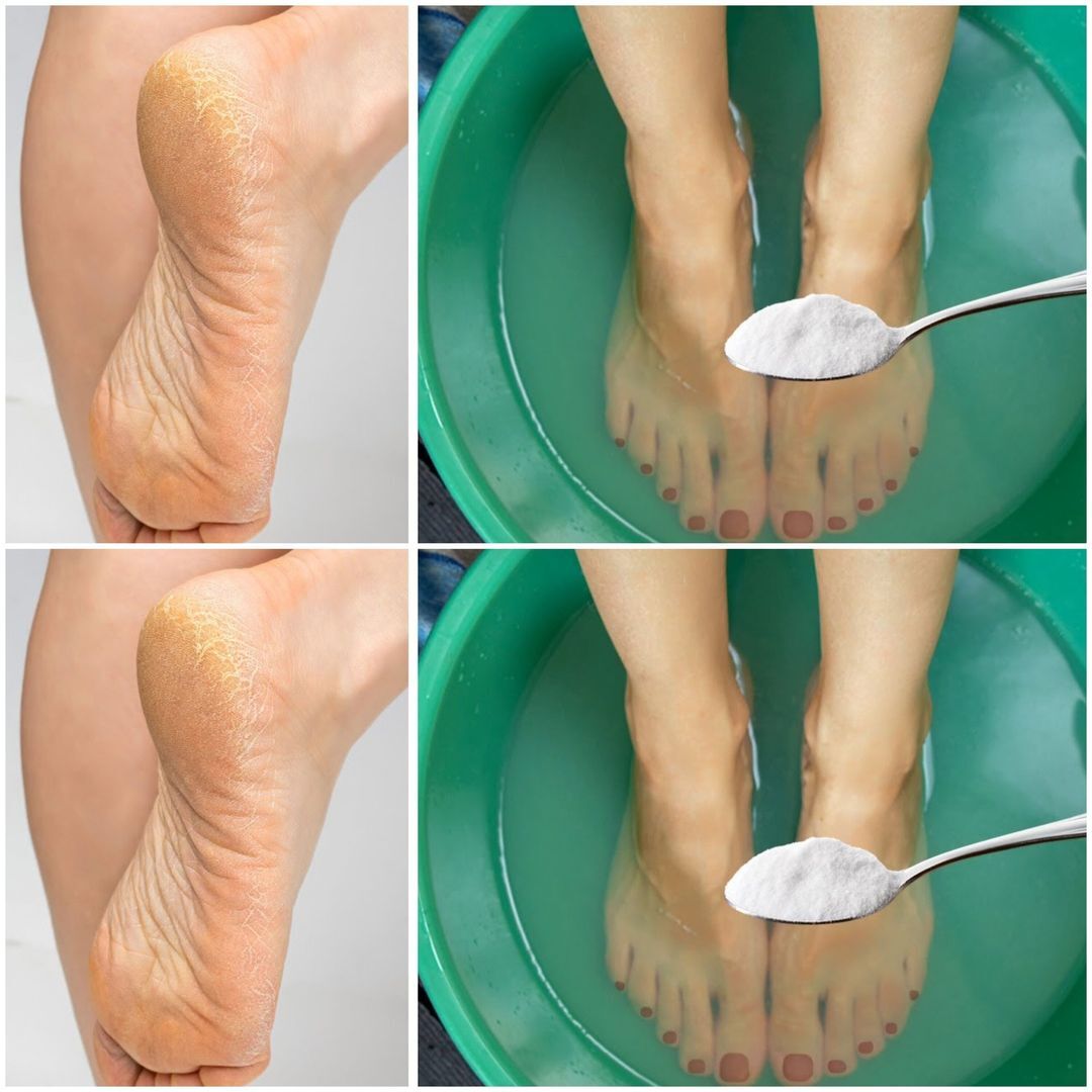 Say Goodbye to Cracked Heels Forever: A Magical Home Remedy