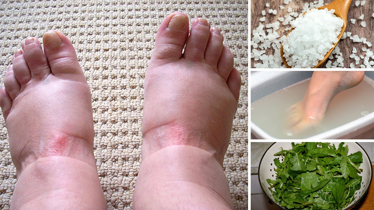 Gentle Relief: Home Remedies for Swollen Feet