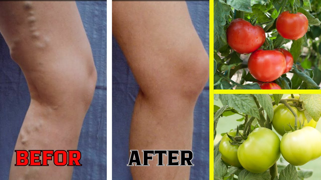 Nurturing Your Legs: Harnessing the Healing Power of Tomatoes for Varicose Veins