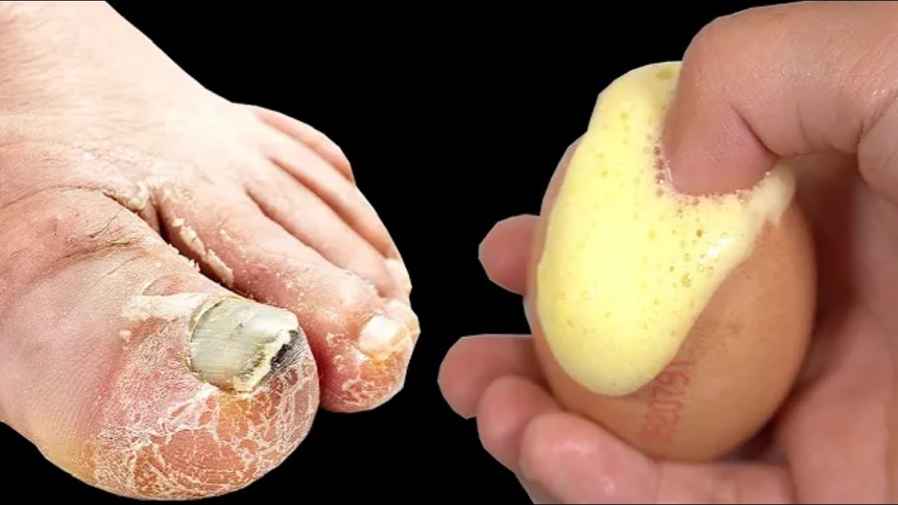 Banish Toenail Fungus with an Egg and Baking Soda Solution!