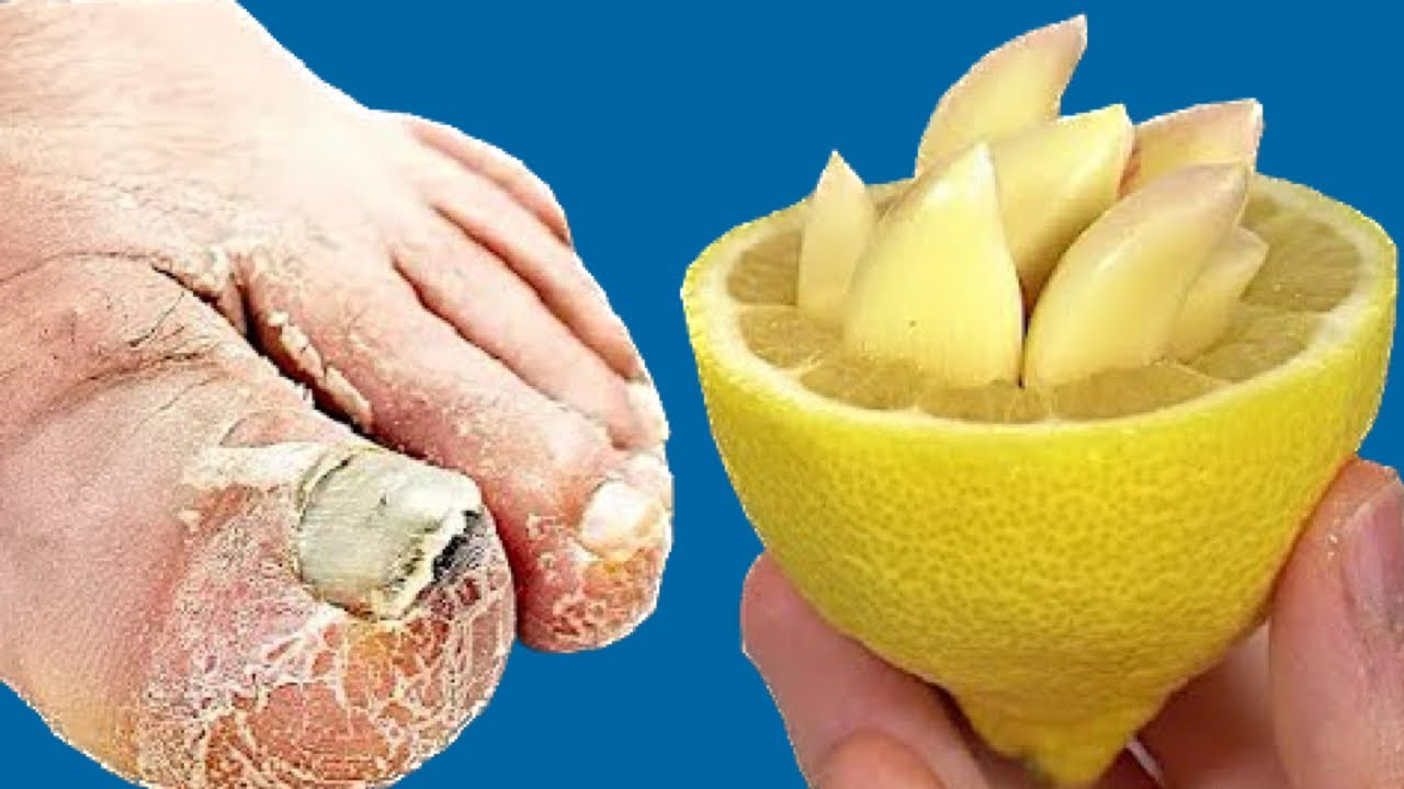 Say Goodbye to Toenail Fungus: Natural Treatment with Garlic and Lemon