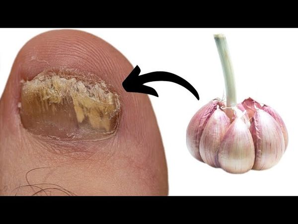 Managing Fungal Foot Infections with Garlic: A Natural Remedy