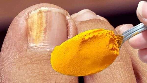 Turmeric: Your Natural Ally in Fighting Toenail Fungus