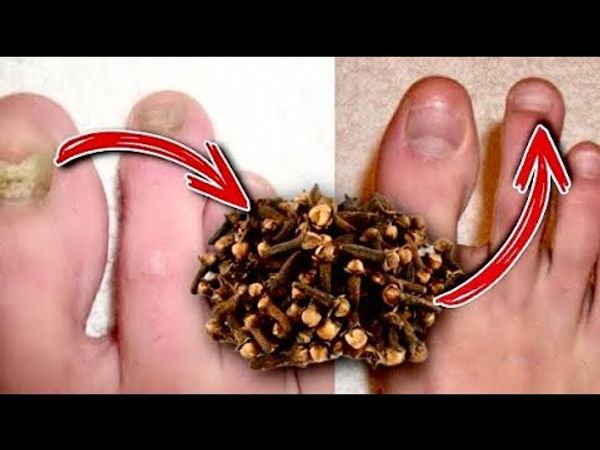 Dealing with Toenail Fungus? Try Cloves!